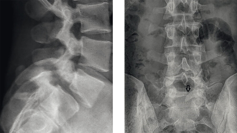 Skelettale Veränderungen 3.8: Spondylolyse