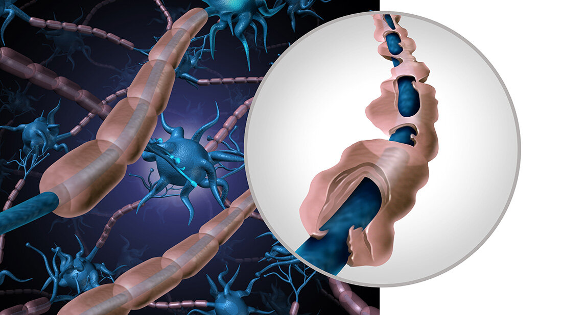 Myelinschicht.jpg Darstellung von Nervenzellen mit Myelinscheiden und einer Vergrößerung, die eine beschädigte Myelinschicht zeigt, symbolisiert neurologische Erkrankungen.