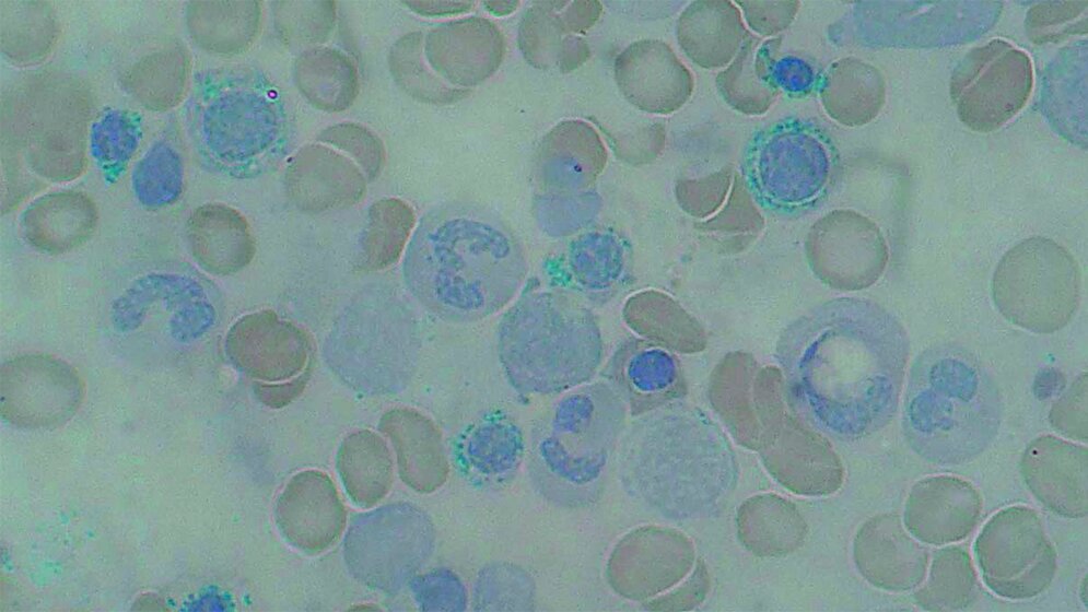 Porphyrine – Porphyrien Labordiagnostik