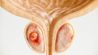 Abbildung eines Prostatatumors