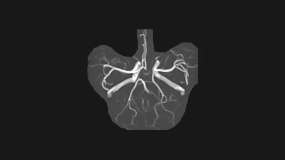 Anomalien und Normvarianten: Vaskuläre Veränderungen 1.4