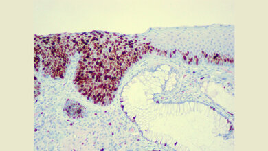 Anales Plattenepithelkarzinom