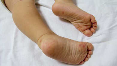 Hand-Fuß-Mund-Krankheit oder Tomatengrippe?