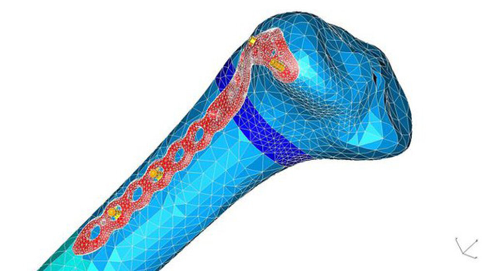 Einsatz Virtueller Techniken in der Medizin und Medizintechnik FEA-Simulation eins Oberschenkelimplantates