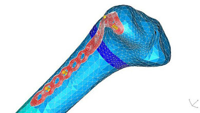 FEA-Simulation eins Oberschenkelimplantates