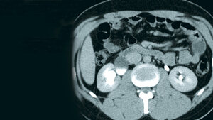 Zufallsbefunde: Harnstau