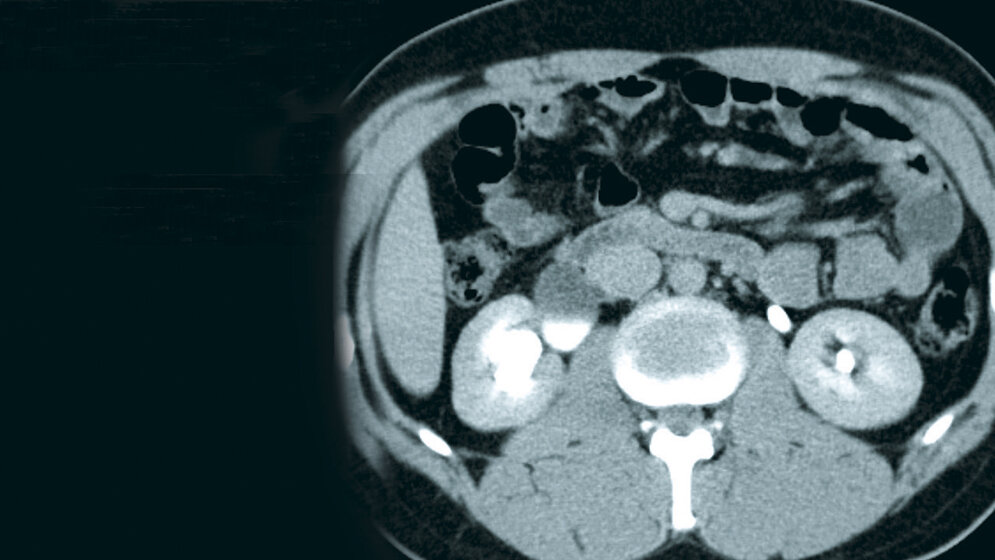 Zufallsbefunde: Harnstau