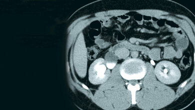 Zufallsbefunde: Harnstau