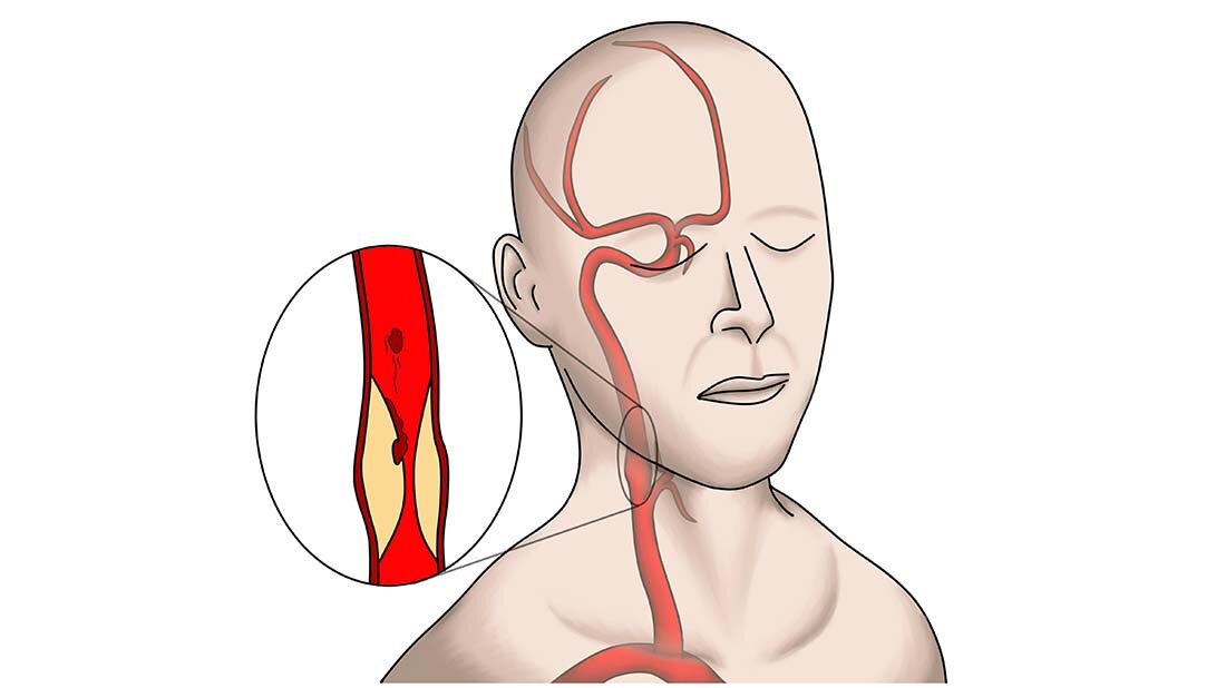 carotitisstenose.jpg carotitisstenose.jpg