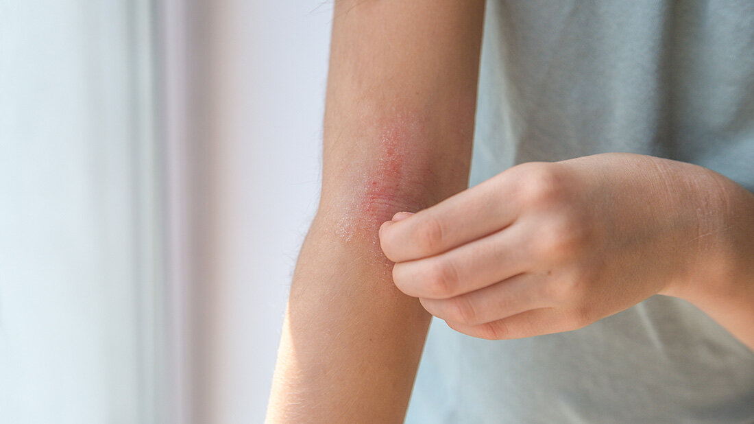 Frau kratzt sich an geröteter und trockener Haut in der Ellenbeuge, nur der Teil des Armes und die kratzende Hand sind sichtbar