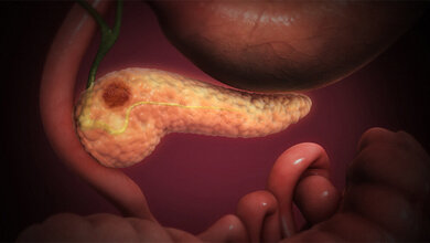 Pankreaskarzinom_Scientific_Animations_Inc__CC_BY_SA_4_0.jpg Pankreaskarzinom