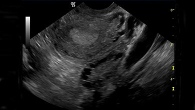 Polyzystisches Ovar-Syndrom