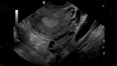 Polyzystisches Ovar-Syndrom
