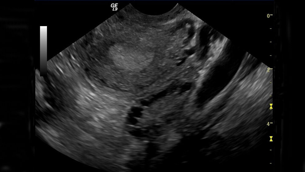 Polyzystisches Ovar-Syndrom