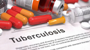 Pulmonary Tuberculosis