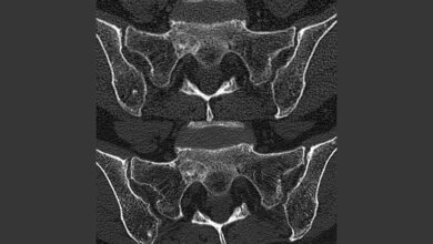Aufnahme des Beckens einer Brustkrebspatientin 