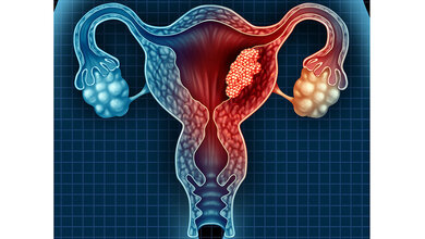 Gebaermutterkoerperkrebs.jpg Endometriumkarzinom