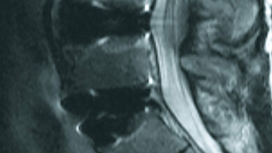 Postoperative Veränderungen: Spondylodese, Bandscheibenersatz und Interspacer