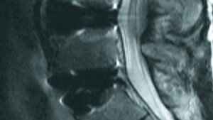 Postoperative Veränderungen: Spondylodese, Bandscheibenersatz und Interspacer