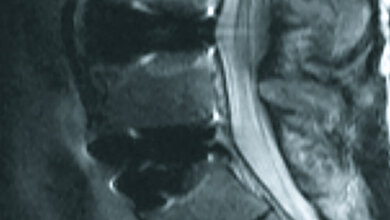 Bildgebende Verfahren Postoperative Veränderungen: Spondylodese, Bandscheibenersatz und Interspacer