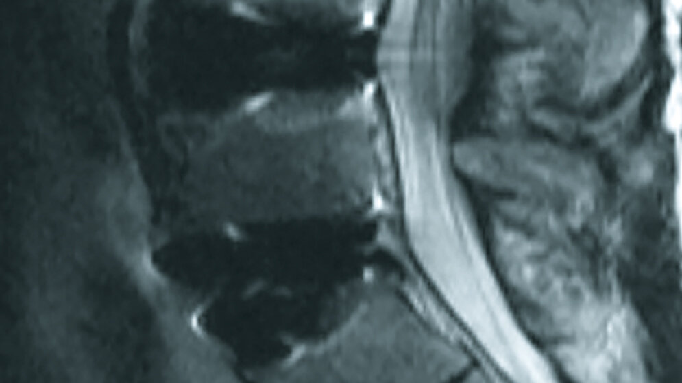 Postoperative Veränderungen: Spondylodese, Bandscheibenersatz und Interspacer