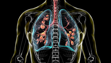 Lunge mit zystischer Fibrose