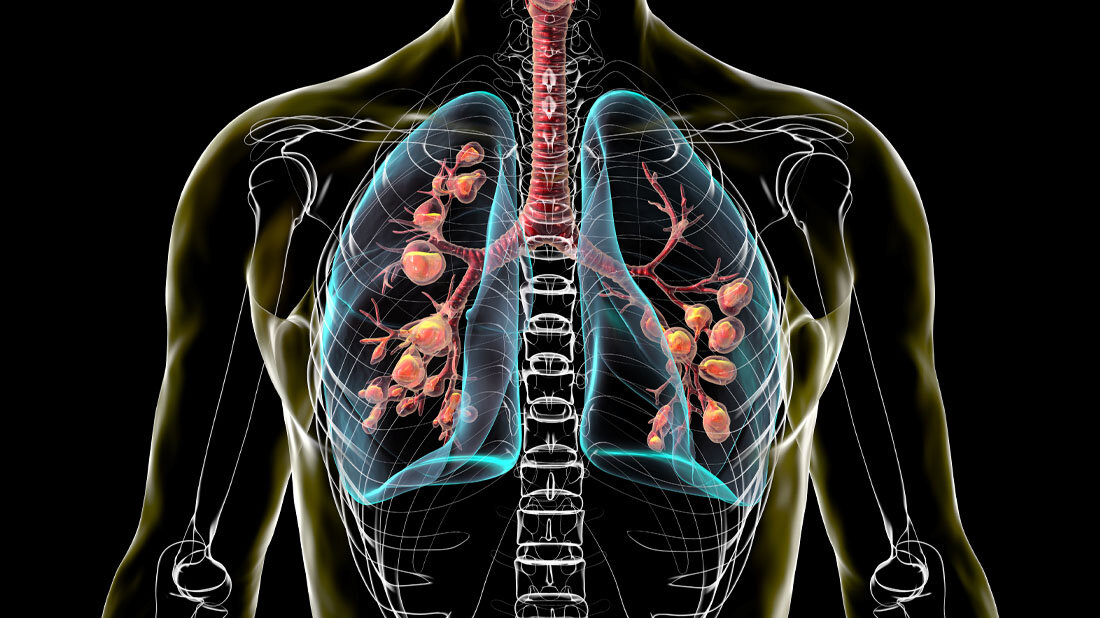 zystische_Fibrose.jpg Lunge mit zystischer Fibrose