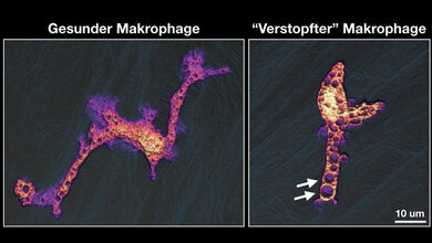 Abwehrzelle_und_aufgenommene_Fluessigkeit_S_Uderhardt_Uni_Klinikum_Erlangen.jpg Schafft es die Abwehrzelle nicht die aufgenommene Flüssigkeit wieder abzugeben, vergrößern sich die Vakuolen