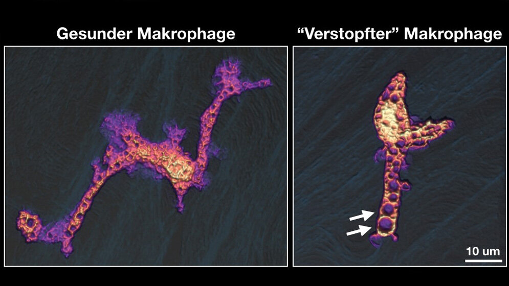 Abwehrzelle_und_aufgenommene_Fluessigkeit_S_Uderhardt_Uni_Klinikum_Erlangen.jpg Schafft es die Abwehrzelle nicht die aufgenommene Flüssigkeit wieder abzugeben, vergrößern sich die Vakuolen