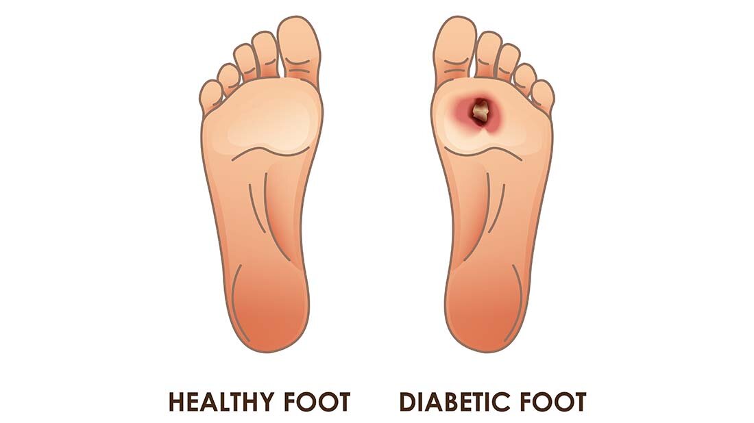 Diabetisches_Fusssyndrom.jpg Wirkungsmechanismen der Kaltplasmatherapie