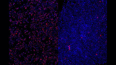 Nach einer Behandlung der Zellen mit einem ASO gegen SCN2A zeigt sich eine deutliche Verminderung des roten Signals, was die Effektivität des ASOs verdeutlicht (rechtes Bild). 