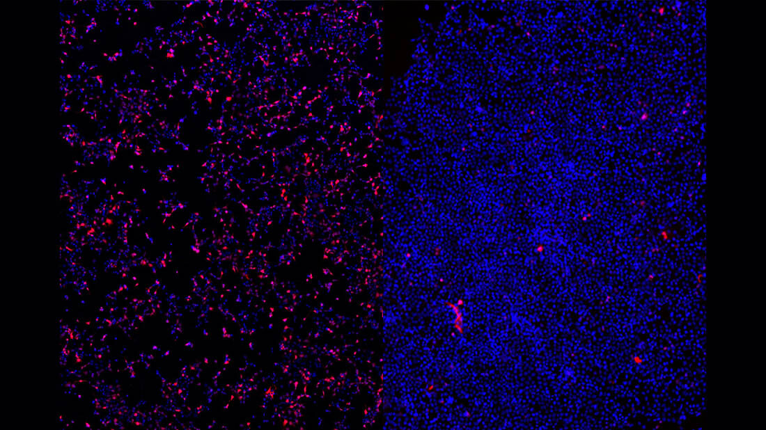 Epilepsie_TUM.jpg Nach einer Behandlung der Zellen mit einem ASO gegen SCN2A zeigt sich eine deutliche Verminderung des roten Signals, was die Effektivität des ASOs verdeutlicht (rechtes Bild).