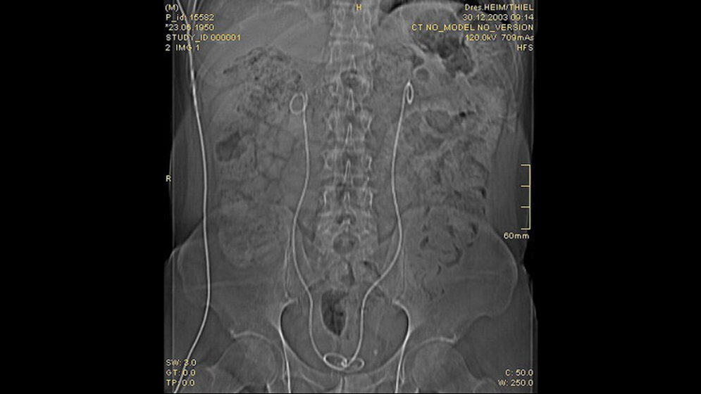 Schnittbilddiagnostik der Wirbelsäule (4.17)
