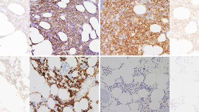 CD138-positive Myelomzellen