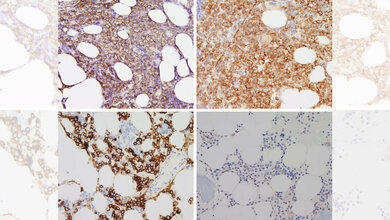 CD138-positive Myelomzellen