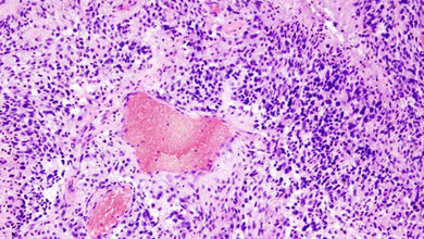 Glioblastoma__3_.jpg Glioblastom histologisches Präparat