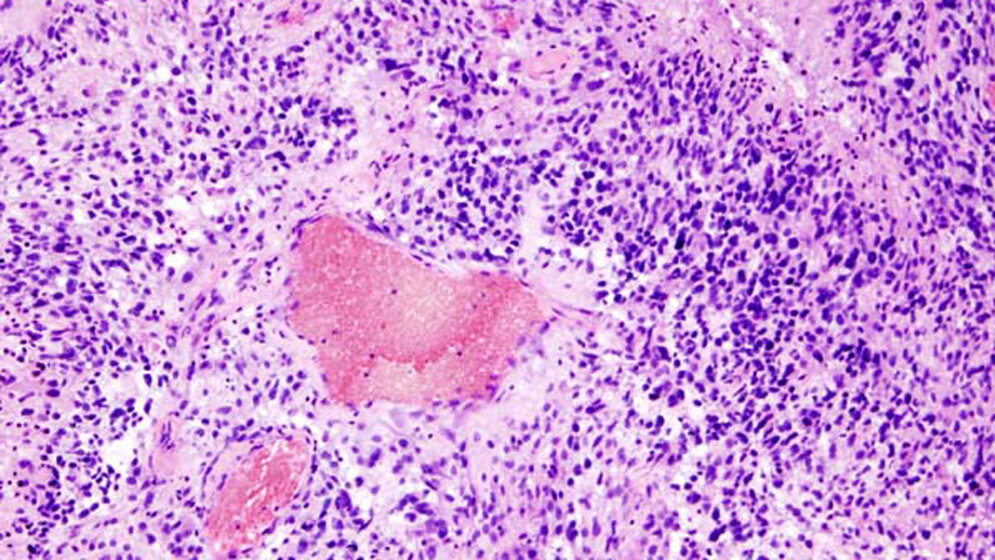 Glioblastom histologisches Präparat