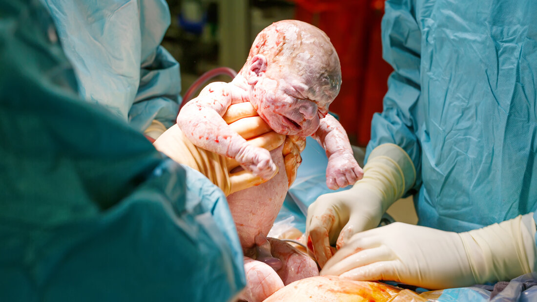 Geburt mit Kaiserschnitt
