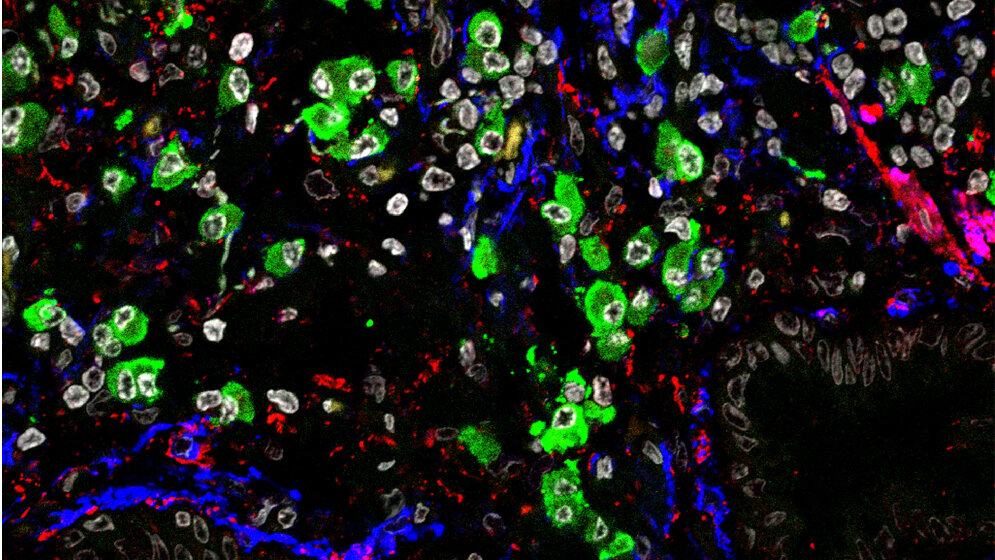Mikroskopische Aufnahme von vernarbtem Lungengewebe