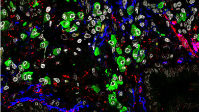 Mikroskopische Aufnahme von vernarbtem Lungengewebe