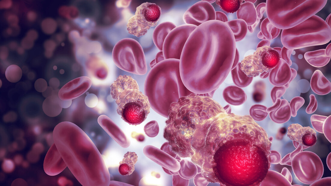 Plasma_Tumorzellen_Adobe.jpg Liquid Biopsy bei Prostatakarzinomen