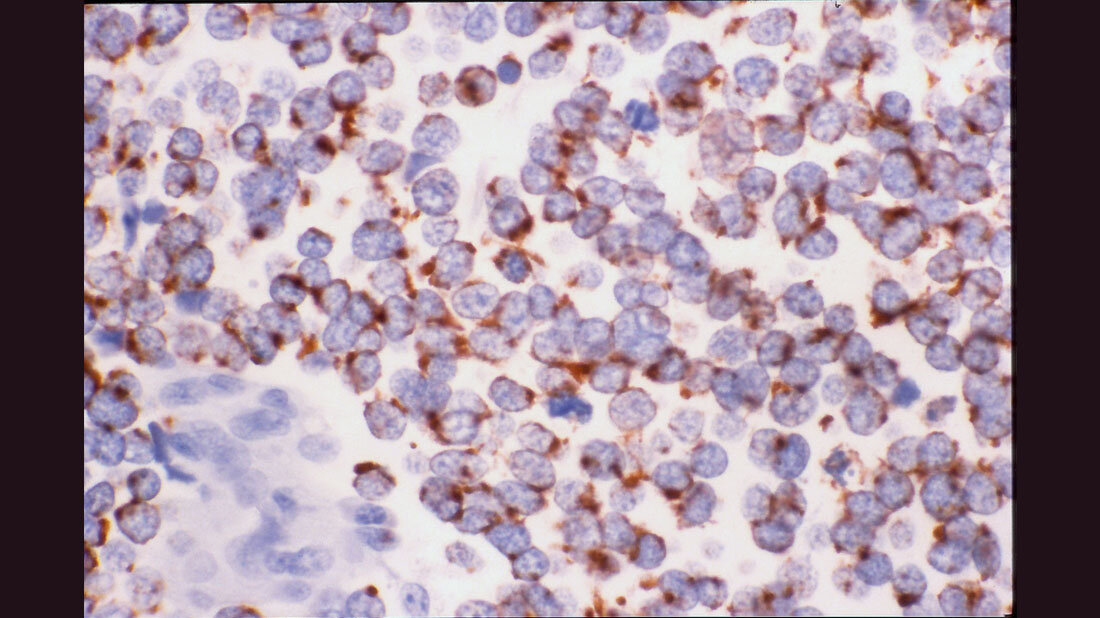 SCLC.jpg Small cell lung carcinoma