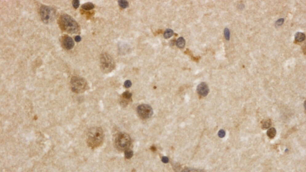 Verklumpungen des Huntington-Eiweißes