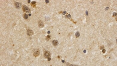 Verklumpungen des Huntington-Eiweißes