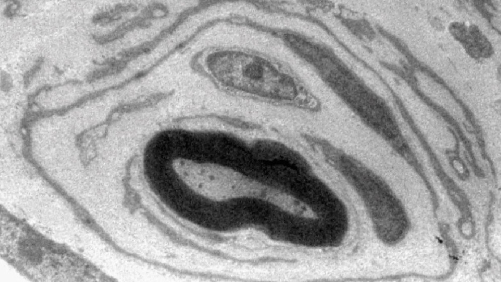 Elektronenmikroskopische Aufnahme eines an CMT1A erkrankten Nervs