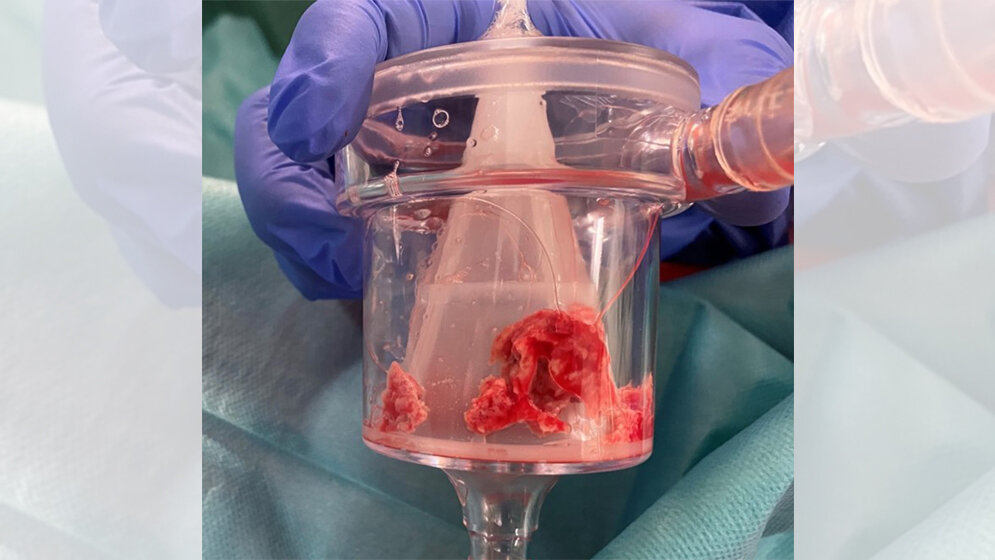 Blutgerinnsel im Filter