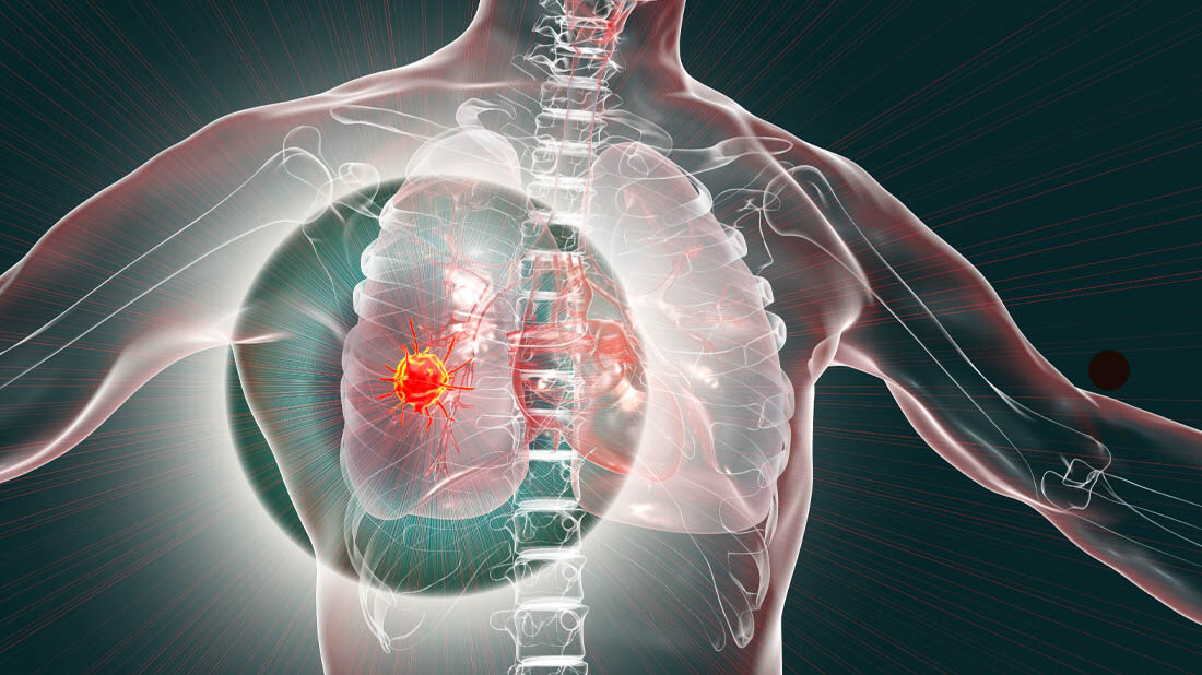 Lungenkrebs.jpg Individualisierte Therapien bei Lungenkrebs