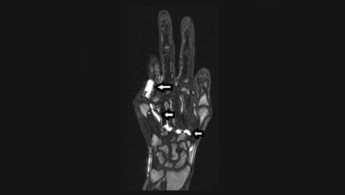 Arterielle MRA: Kontrastierung der vaskularen Malformation der Hand