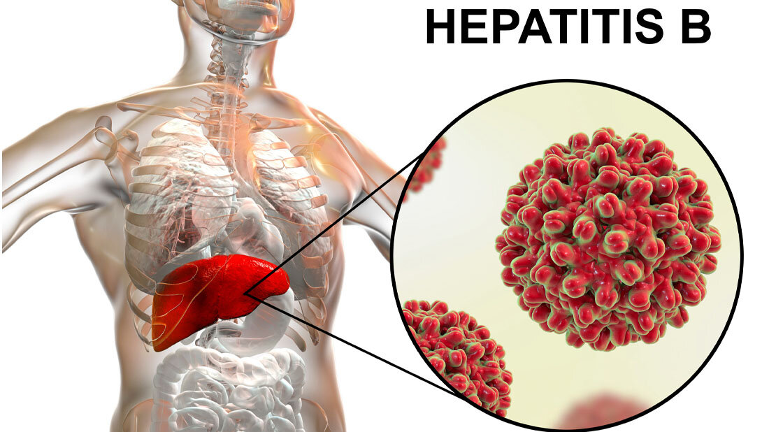 Symbolbild für eine Infektion mit Hepatitis B.