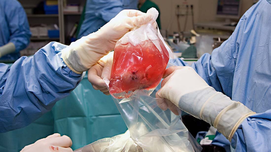 Ein am Uniklinikum Dresden entwickeltes digitales Tool hilft erfolgreich beim Identifizieren potenzieller Organspenden.